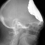 skull-grows-back-xray.jpg