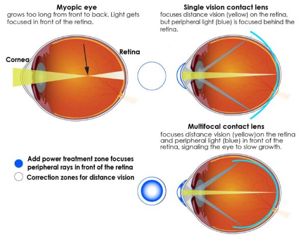 If Children Wear This Type of Contact Lens It Can Stave Off Worsening ...