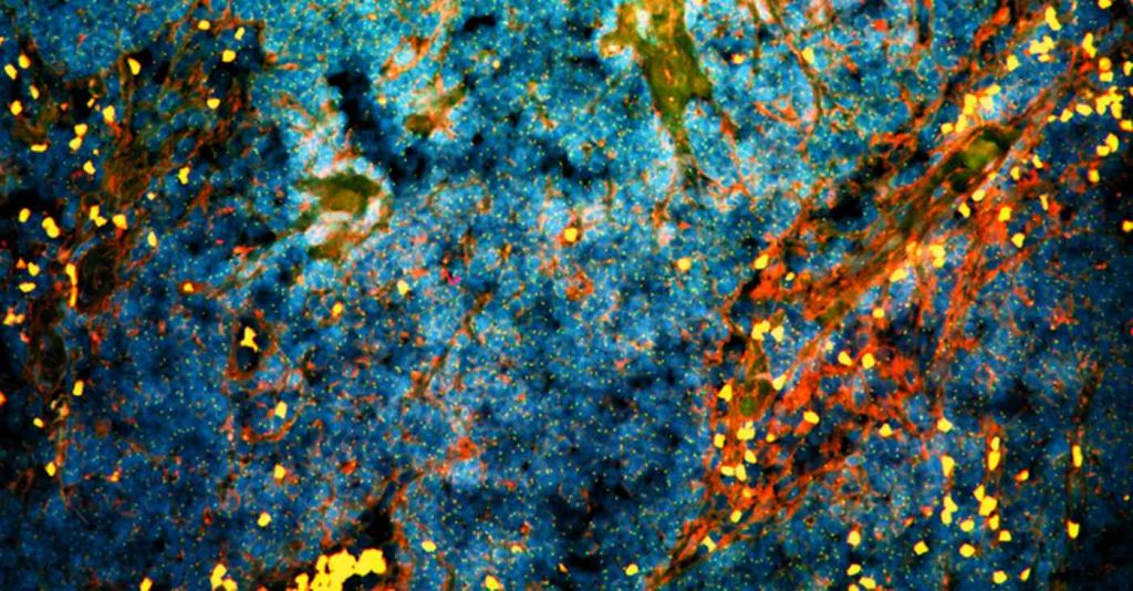 Scientists Uncover Easy Complement That Reasons Prostate Most cancers Cells To Self-Destruct