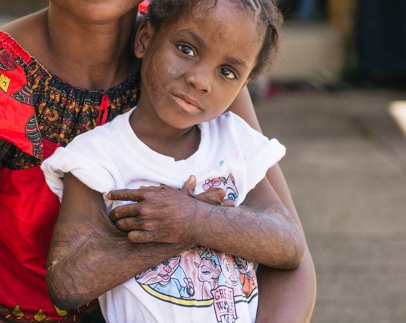 Gamai Couldnt Move Her Arms Due to Burn Scars – Mercy Ships Swns