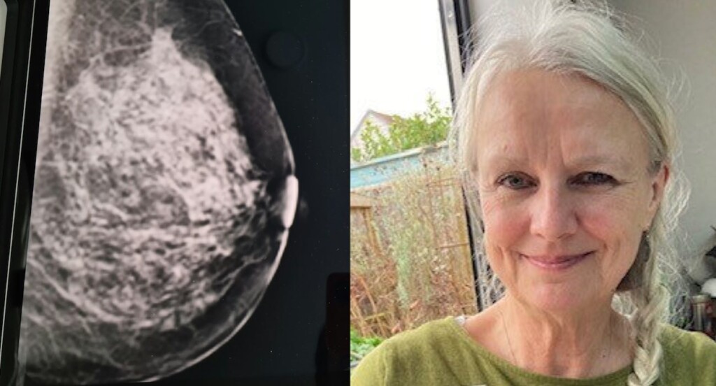 AI Detected Her Early Breast Most cancers After Annual Check Got here Again as Commonplace: ‘I believe so fortunate’