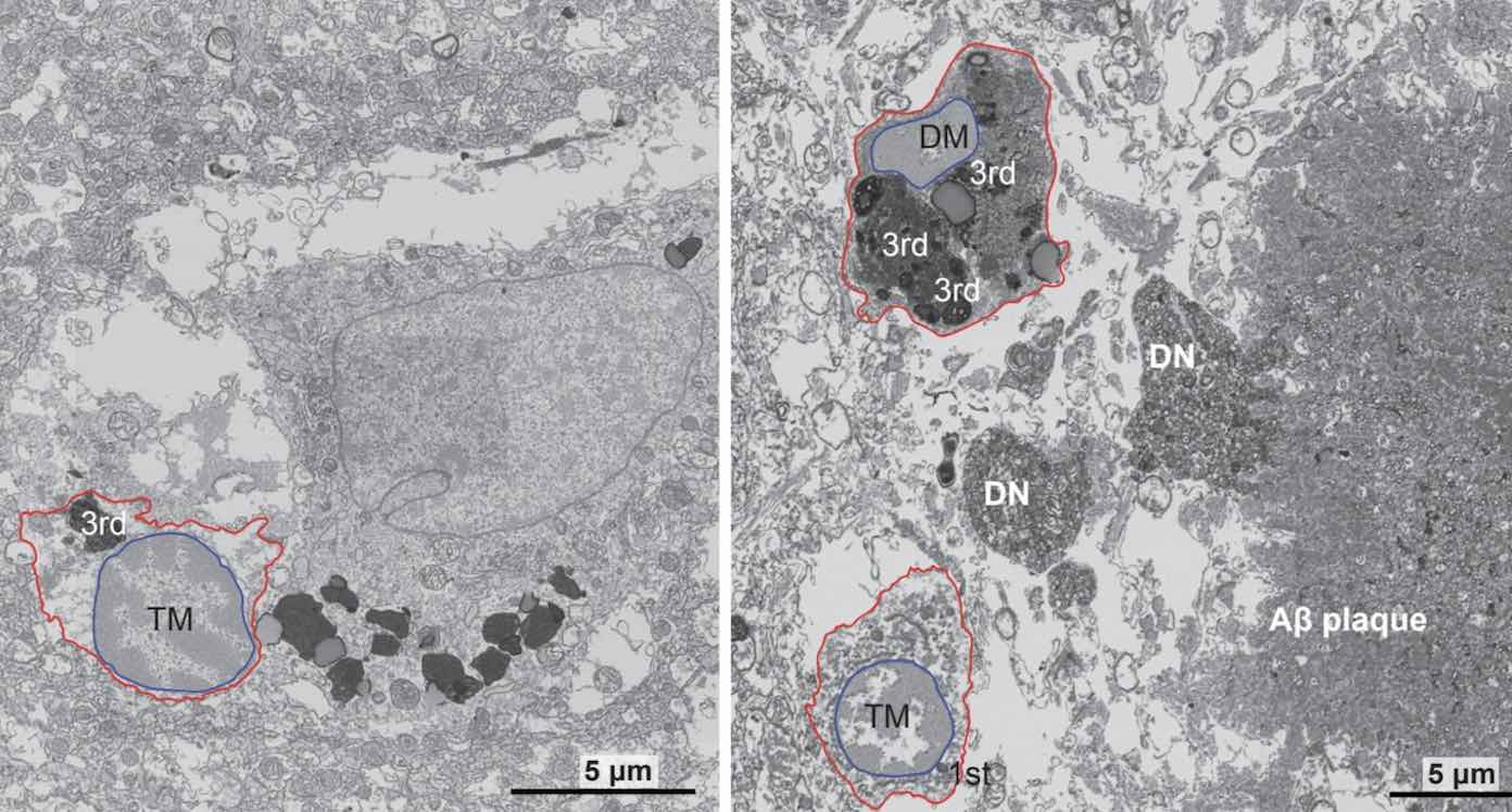 Microglia in Alzheimer's brain study