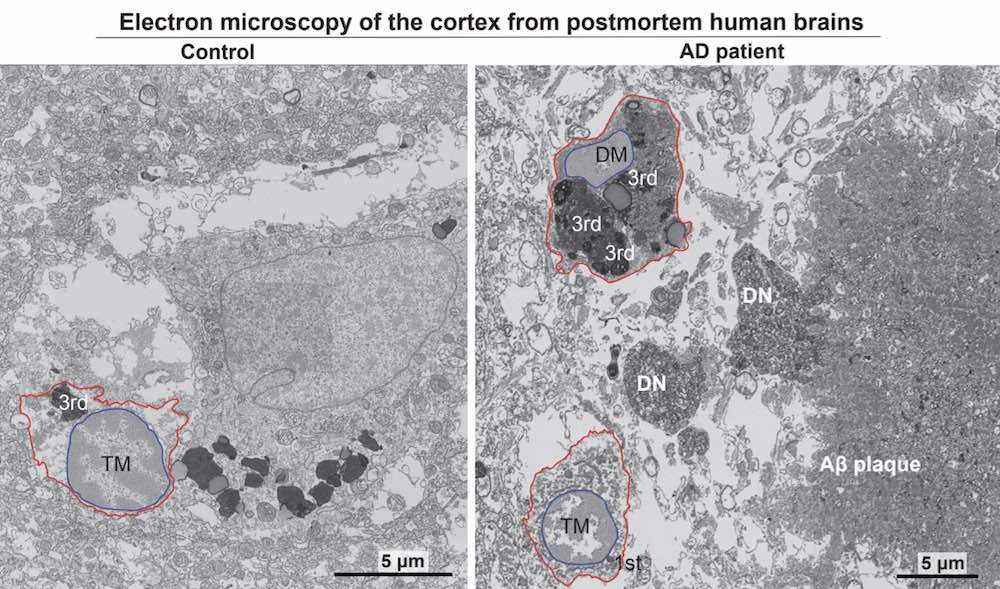 Key Alzheimer’s Leap forward Identifies Tension-Comparable Cell Mechanism Using the Illness