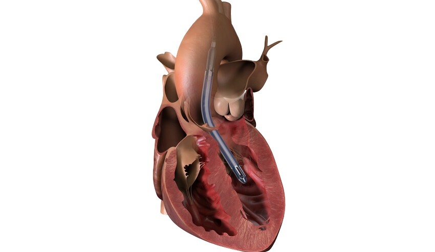 The smallest heart pump in the world “ a game changer ” to maintain the failure of hearts without major surgery

 Aitrend